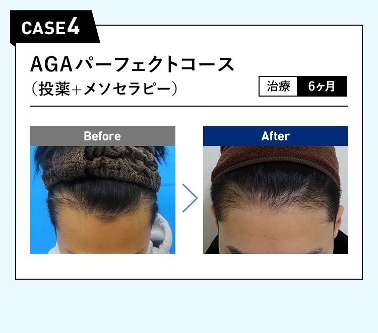CASE4 AGAパーフェクトコース（投薬＋メソセラピー）