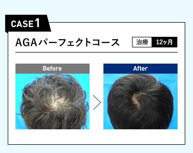 CASE1 AGAパーフェクトコース