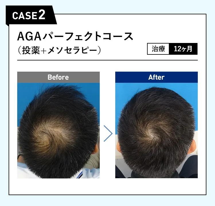 CASE2 AGAパーフェクトコース（投薬＋メソセラピー）