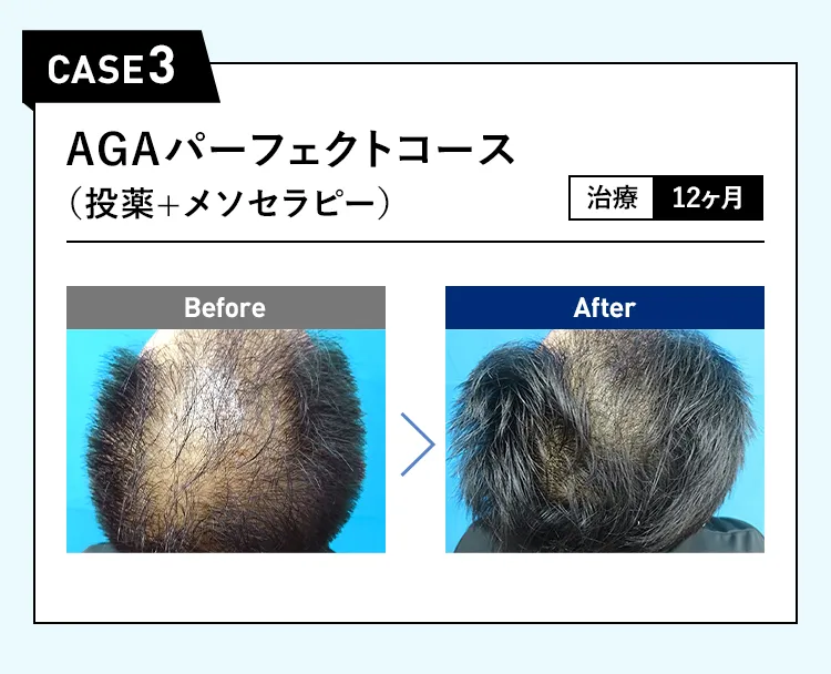 CASE3 AGAパーフェクトコース（投薬＋メソセラピー）