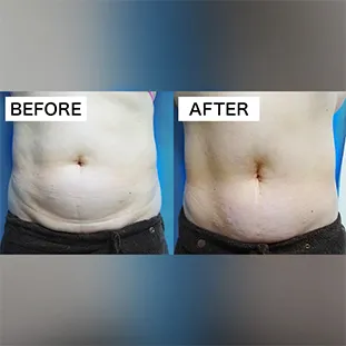 BNLS アルティメットの症例写真