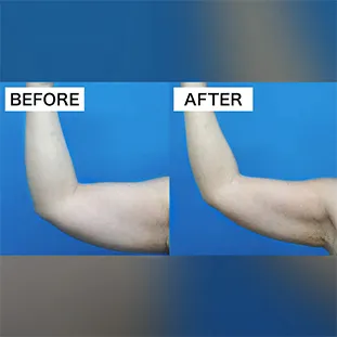 BNLS アルティメットの症例写真