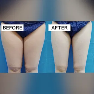 BNLS アルティメットの症例写真