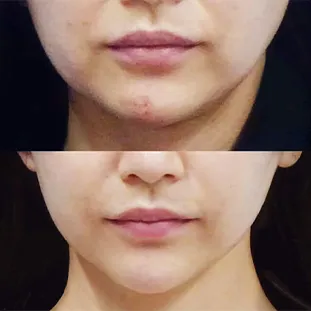 BNLS アルティメットの症例写真