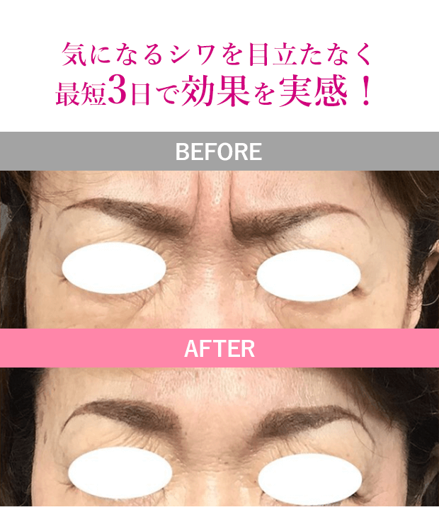 気になるシワを目立たなく｜症例写真