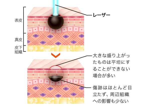 レーザー治療