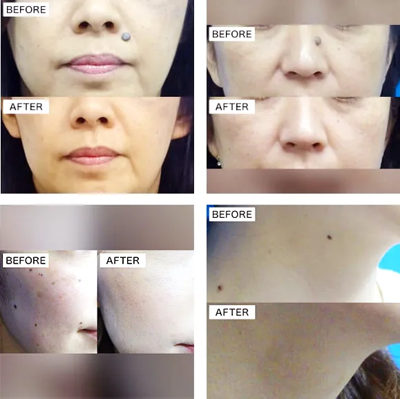 ほくろ除去・症例写真