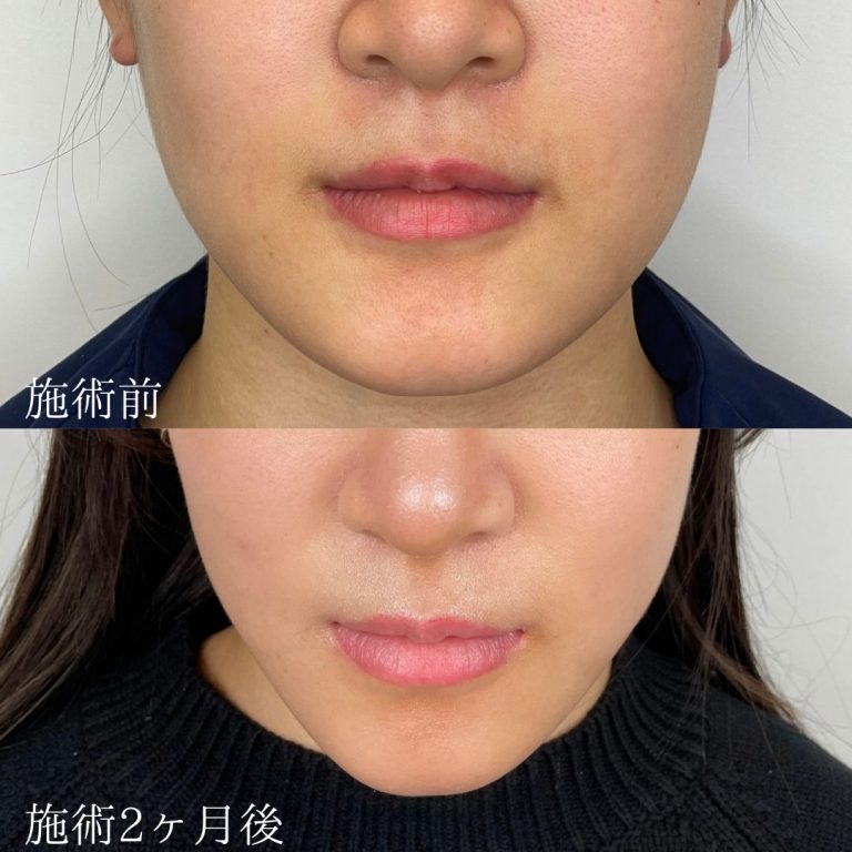 小顔の症例写真
