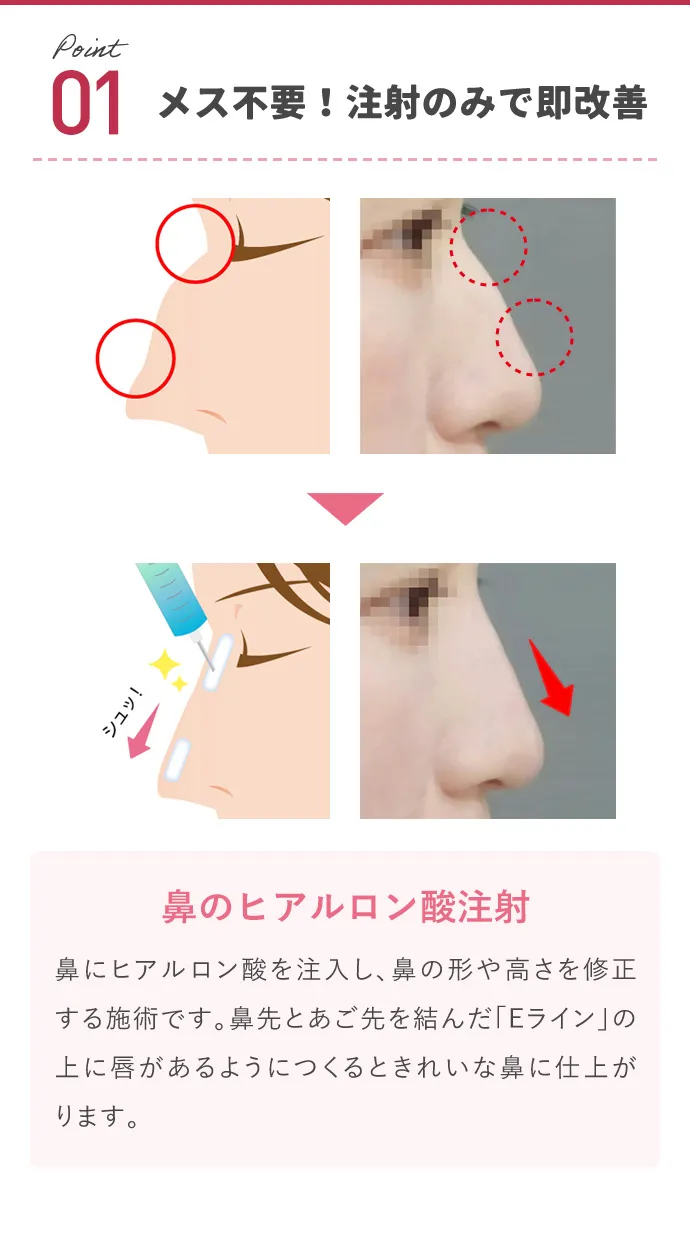 メス不要！注射のみで即改善