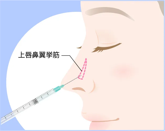 切らない鼻尖形成