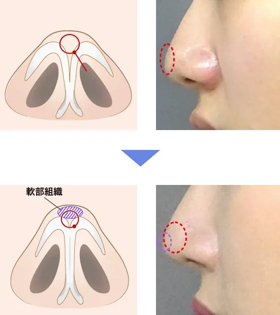 切らない鼻尖形成