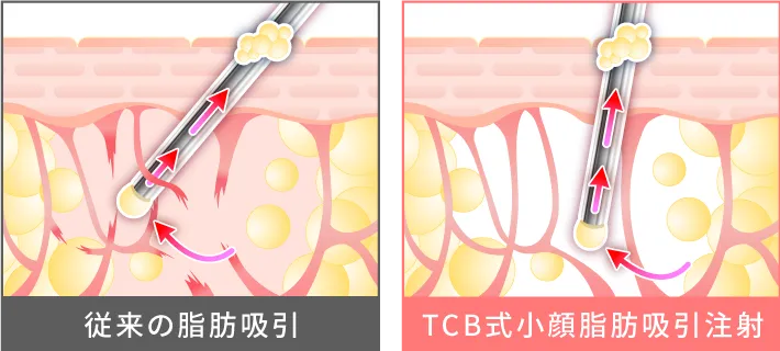 完全オーダーメイドな12G脂肪吸引