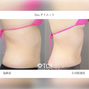 BNLS アルティメットの症例写真