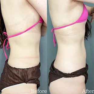 BNLSアルティメット症例写真