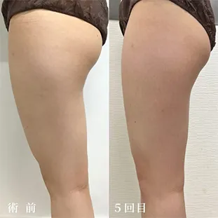 BNLS アルティメットの症例写真