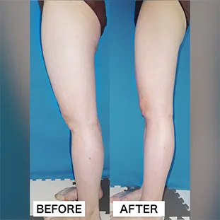 BNLS アルティメットの症例写真