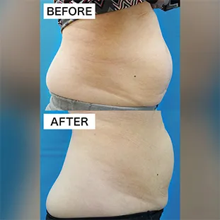 BNLS アルティメットの症例写真