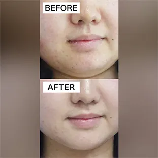 BNLS アルティメットの症例写真