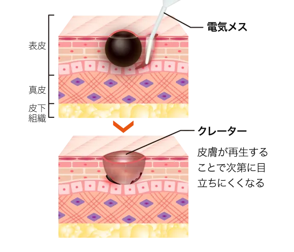 電気メスによる電気分解法
