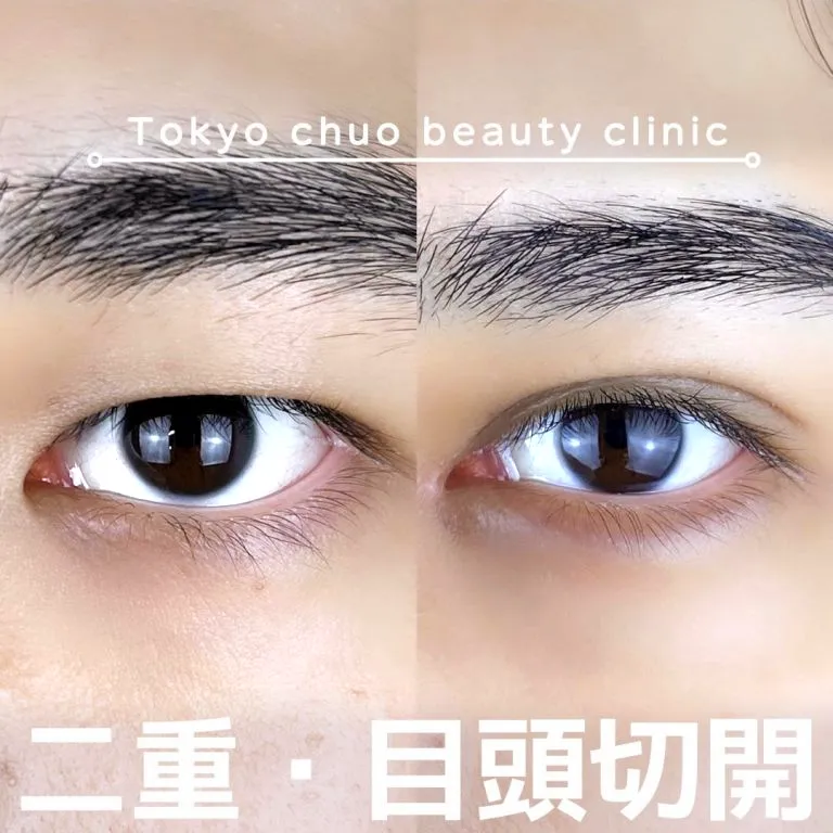 目頭切開の症例写真