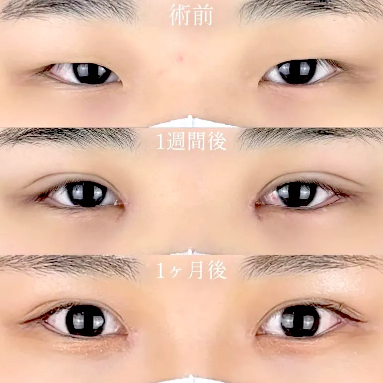 目尻切開の症例写真