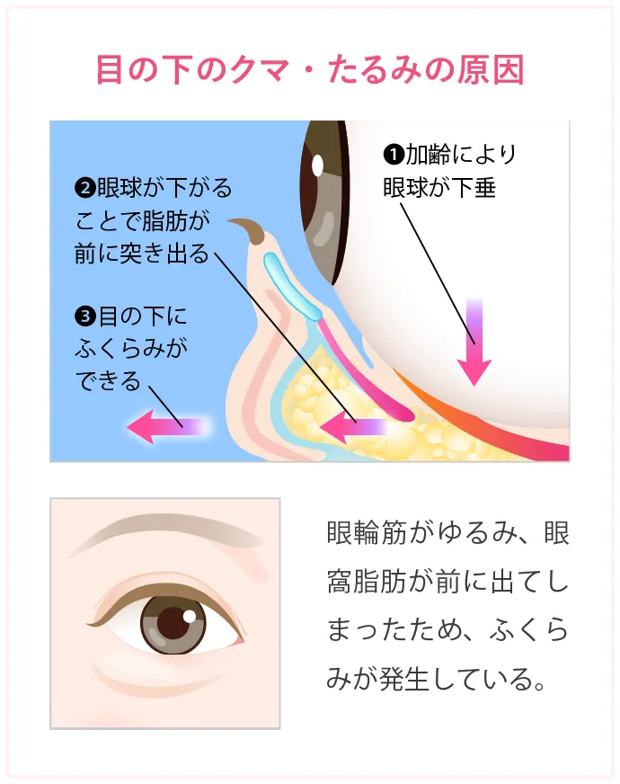 目の下のクマ・たるみの原因