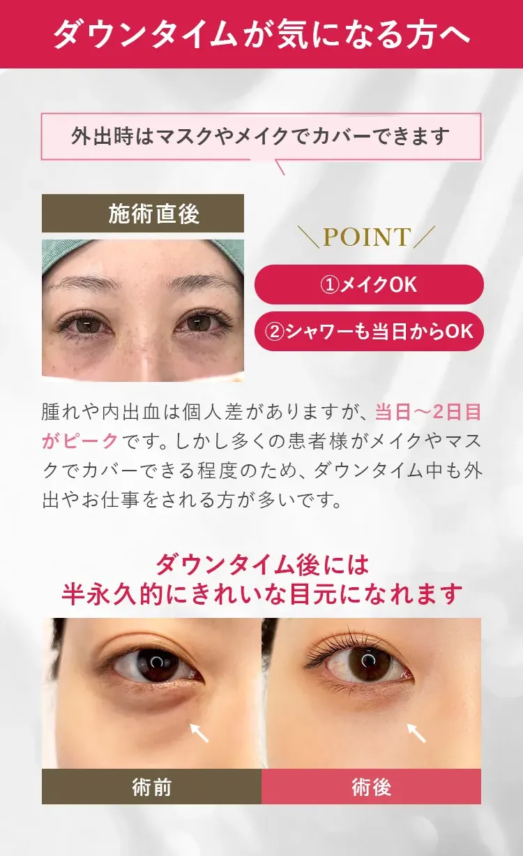 ダウンタイムが気になる方へ