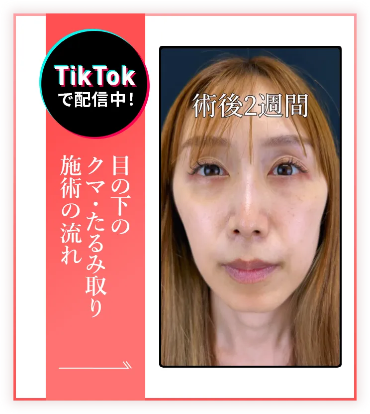 目の下のクマ・たるみ取り 施術中動画