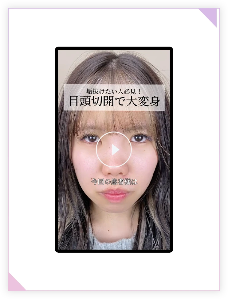 理想の目元をかなえるTCBの目頭切開術