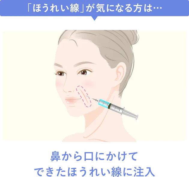 鼻から口にかけてできたほうれい線に注入