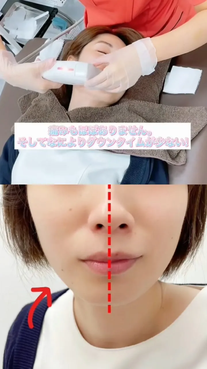 医療ハイフの経過写真