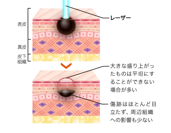 レーザー治療