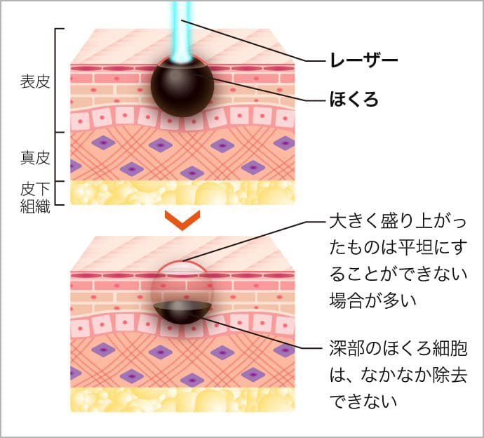 レーザー治療