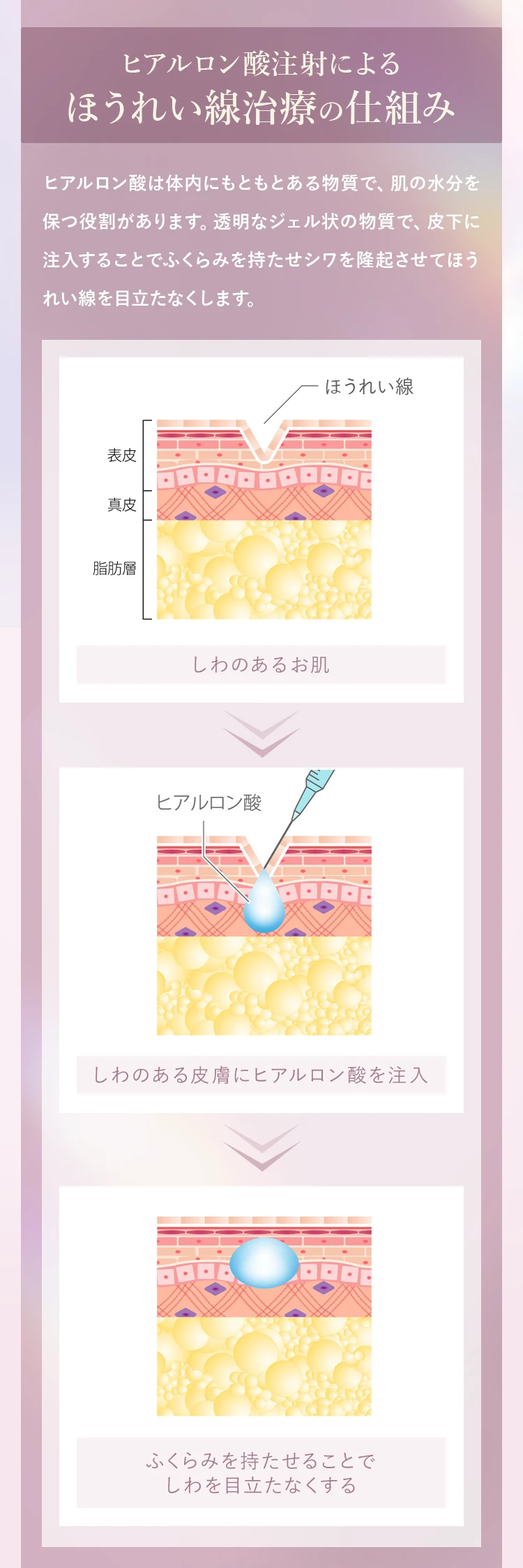 ヒアルロン酸注射によるほうれい線治療の仕組み