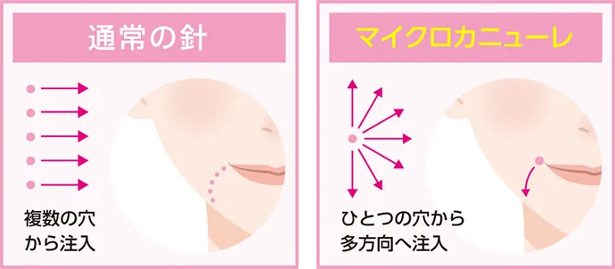 通常の針とマイクロカニューレのイラスト