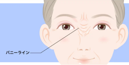バニーラインのボトックス注射症例写真