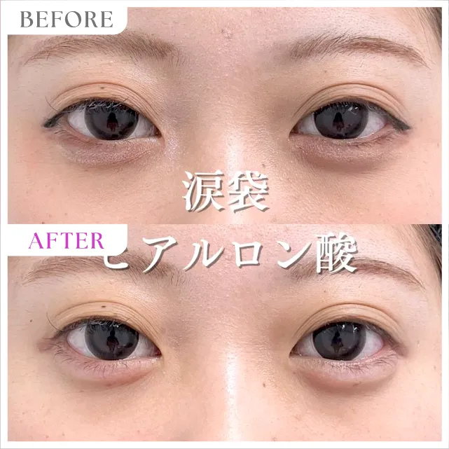 涙袋の症例写真3