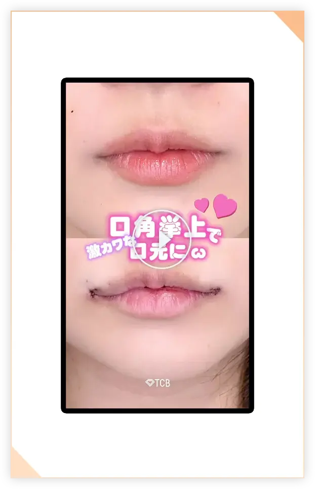 口角挙上の施術動画