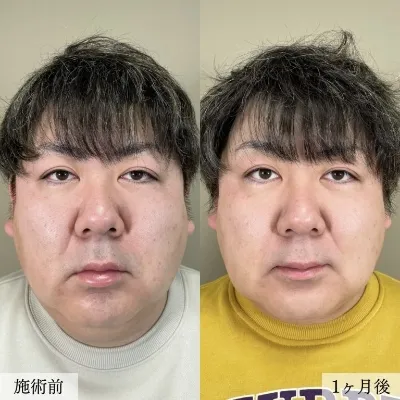輪郭・口周りのもたつき