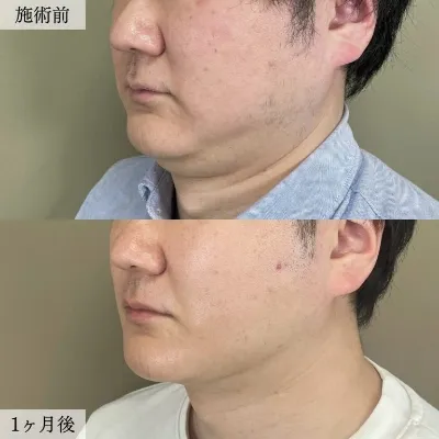 あご下の脂肪