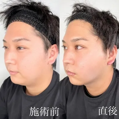 施術直後の写真