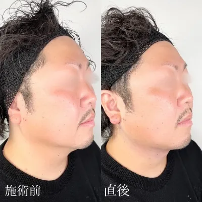 施術術後の写真