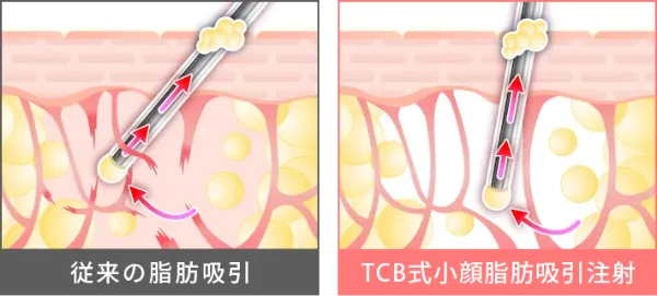 お悩みの部位に合わせて薬剤の量をオーダーメイドで調節！