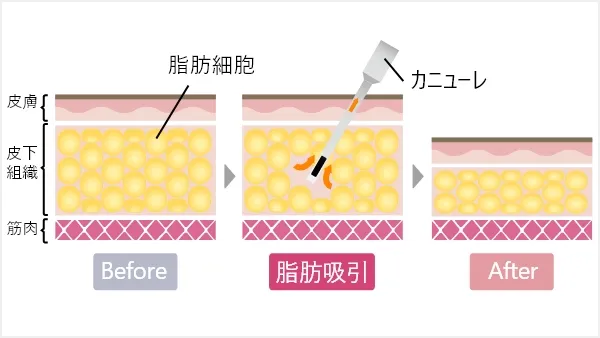 ハイフ(HIFU)とは