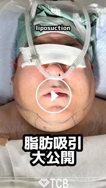理想の小顔を叶える顔の脂肪吸引