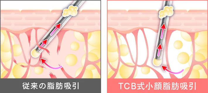 完全オーダーメイドな脂肪吸引
