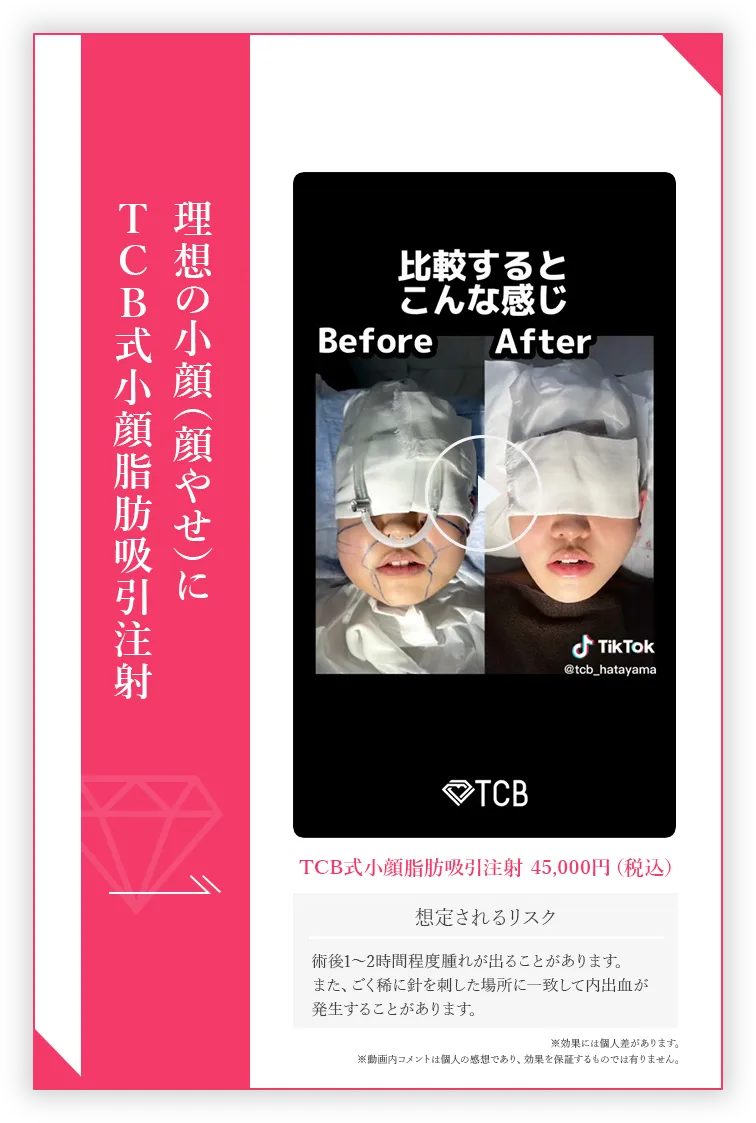 理想の小顔（顔やせ）にTCB式小顔脂肪吸引注射