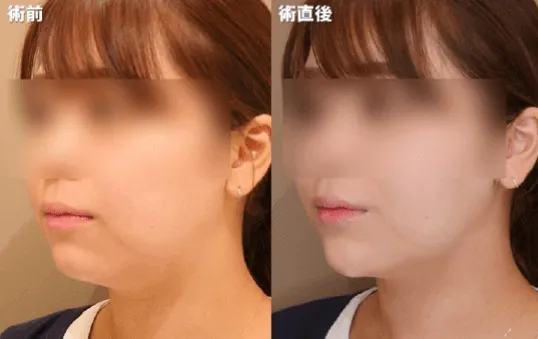 バレづらい仕上がりイメージ