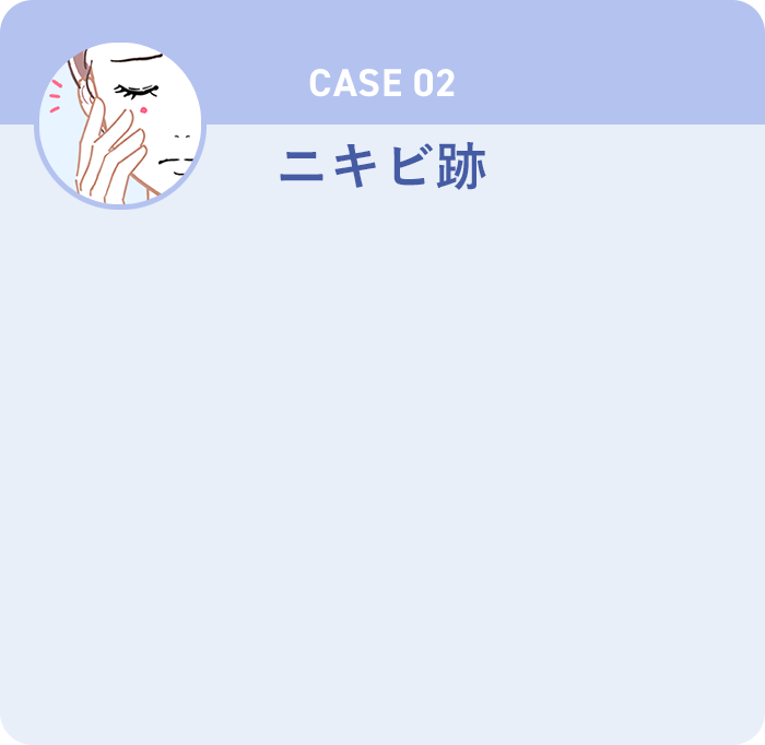 CASE02 ニキビ跡