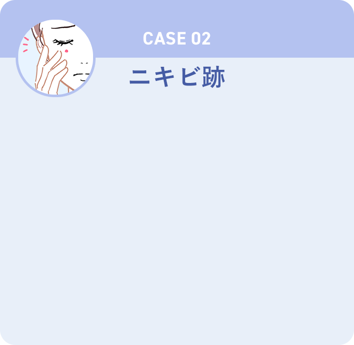 CASE02 ニキビ跡
